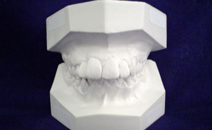 denture mold